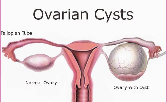 Ovarian Cyst